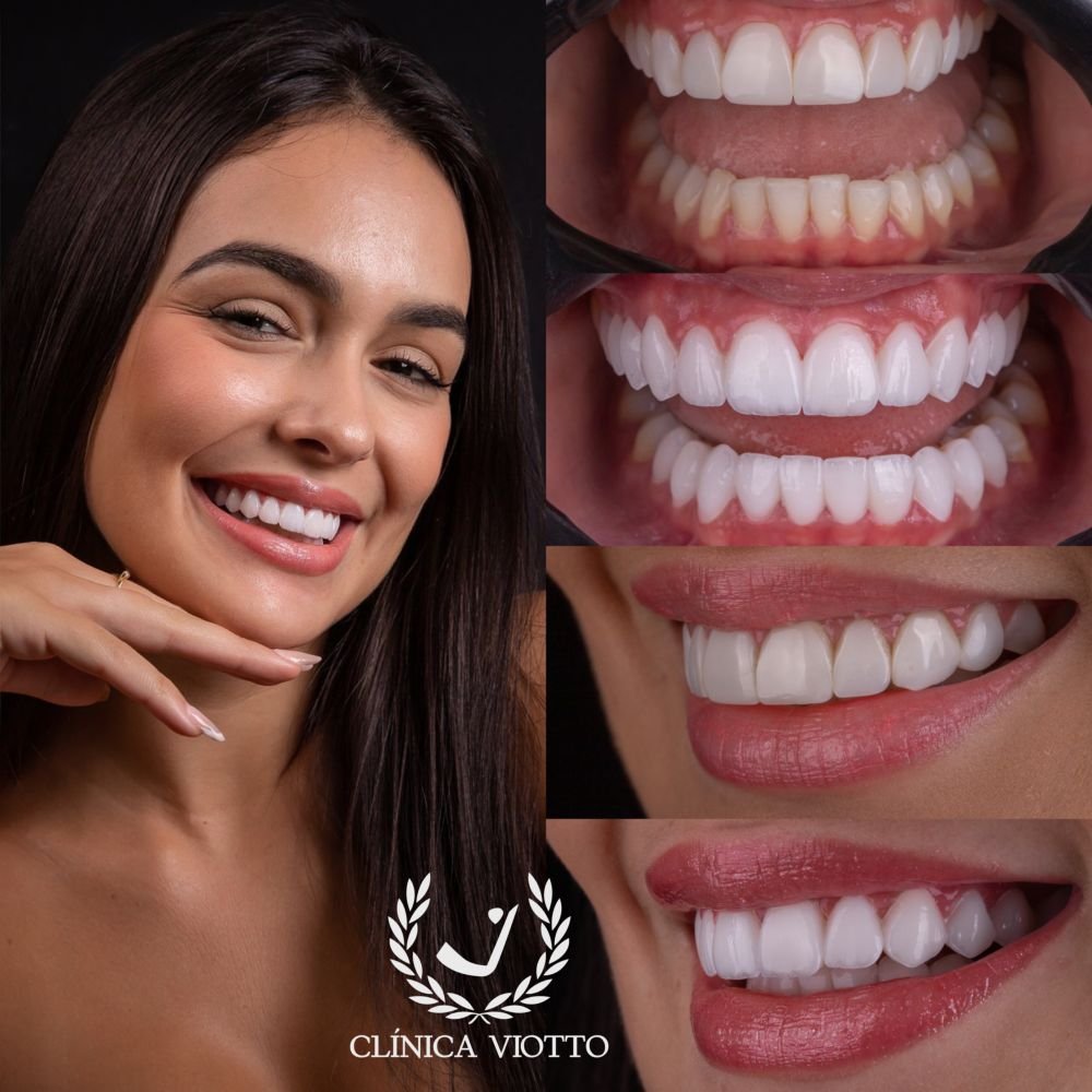 Avaliado Em R$ 60 Mil, Ex Bbb Larissa Santos Troca Lentes De Contato Dental Com Dr Viotto 3 Ex Bbb Larissa Santos - Crédito Da Foto: Divulgação