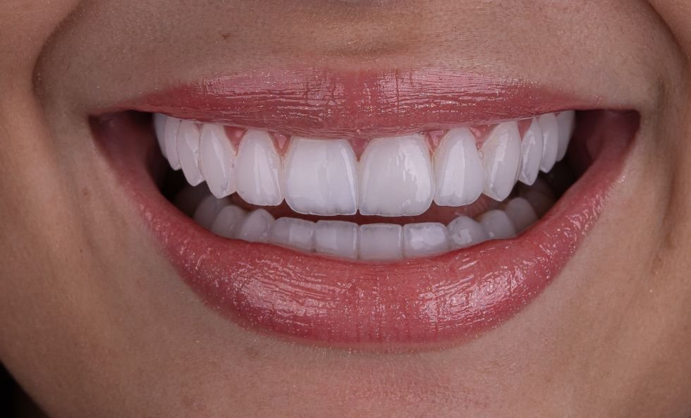 Avaliado Em R$ 60 Mil, Ex Bbb Larissa Santos Troca Lentes De Contato Dental Com Dr Viotto 2 Novo Sorriso Da Ex Bbb Larissa Santos