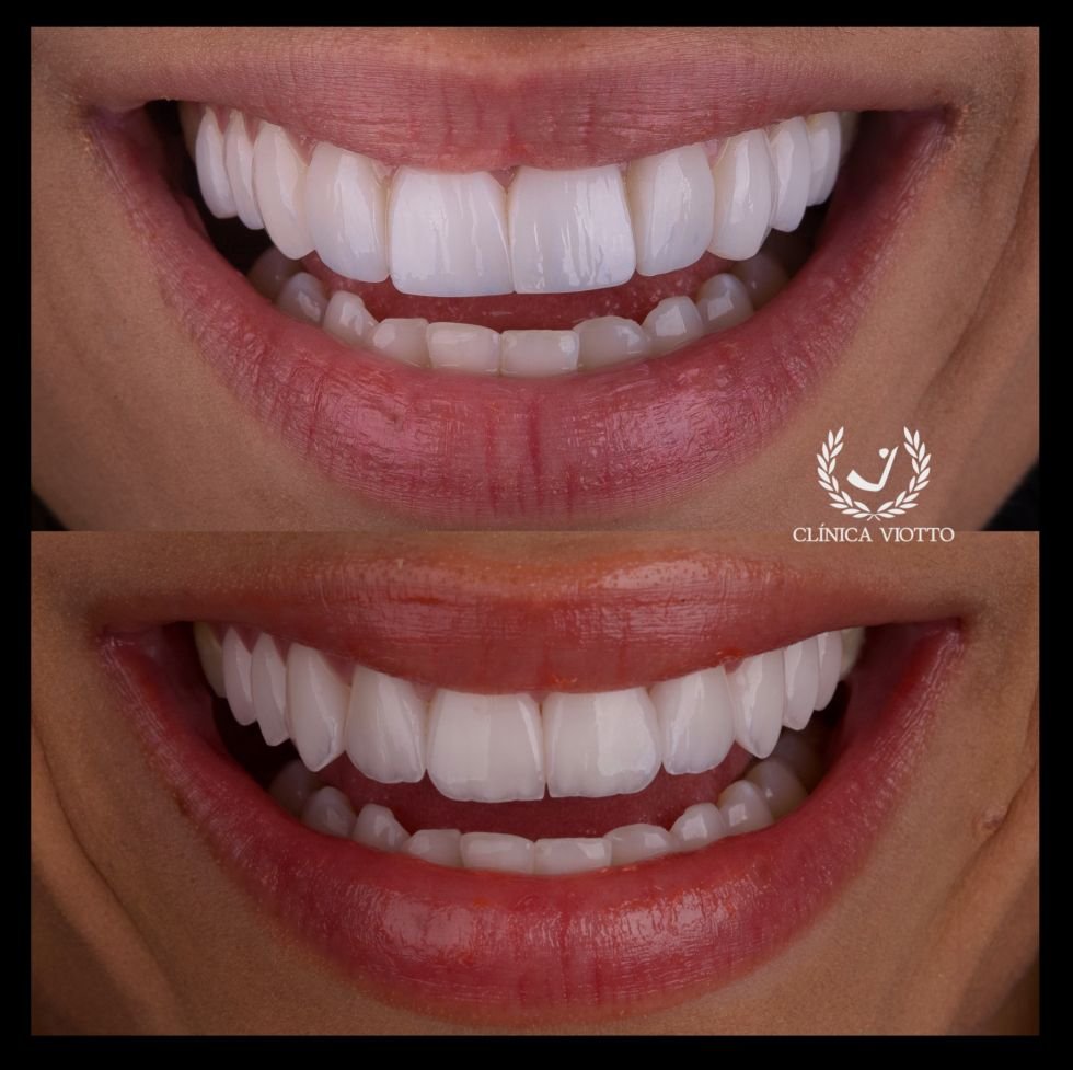 Key Alves Gasta R$30 Mil Para Mudar As Lentes De Porcelana - Veja Antes E Depois 4 Antes E Depois Key Alves - Foto: Clinica Jk Com O Dr. Viotto