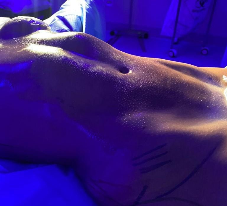 Ex-Bbb Eslovênia Marques Escolheu A Jk Estética Avançada Para A Realização Da Lipoaspiração Conhecida Como Ugraft 2 Ex-Bbb Eslovênia Marques - Crédito Da Foto: Divulgação