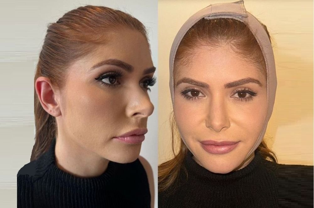 Ex-BBB Amanda Gontijo faz correção de estética das orelhas pelas mãos do noivo, Danilo Monteiro