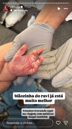 Viih Tube atualiza saúde do filho Ravi após cirurgia por queimadura doméstica 19 Viih Tube atualiza estado de saúde do filho após cirurgia